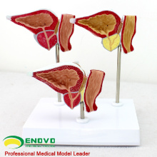 UROLOGY07 (12427) Modelo de Exame de Próstata Humano Patológico para Educação BPH 12427